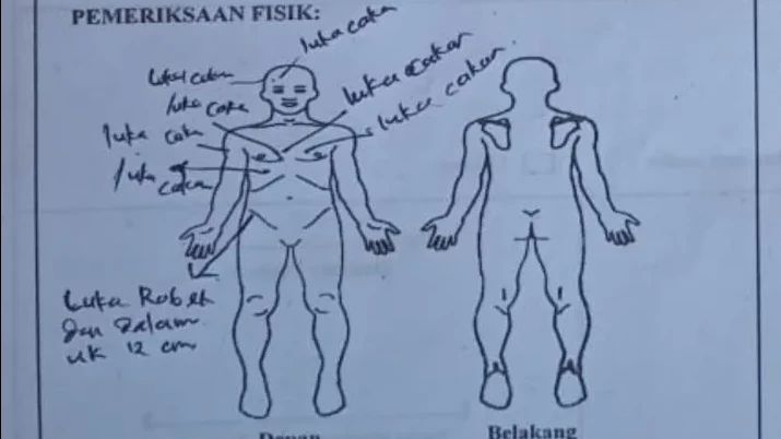 Ngeri! Anak di NTB Digigit Lima Anjing Liar hingga Badan Sobek