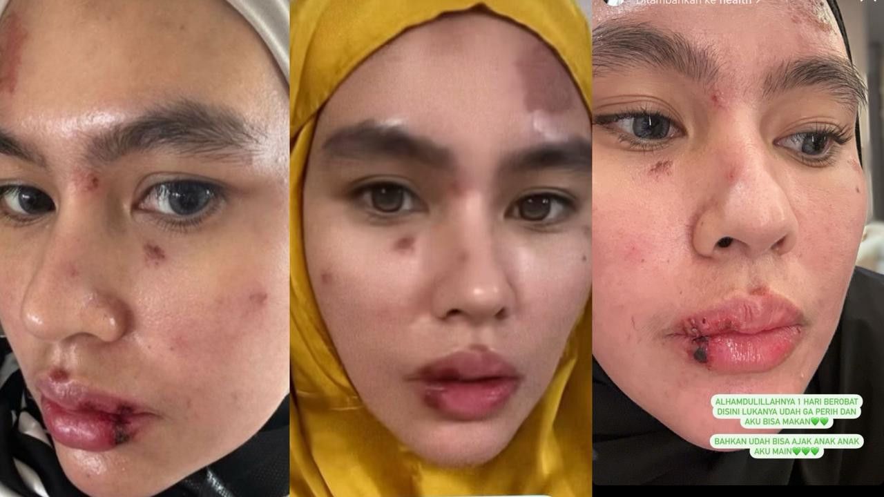 Kartika Putri Alami Autoimun Hingga Wajah dan Lidah Dipenuhi Luka Melepuh, Apa Penyebab dan Gejalanya?