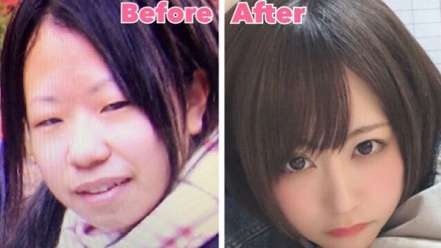 Berubah Drastis, Gadis Jepang Posting Foto Before After Oplas yang Beda Banget