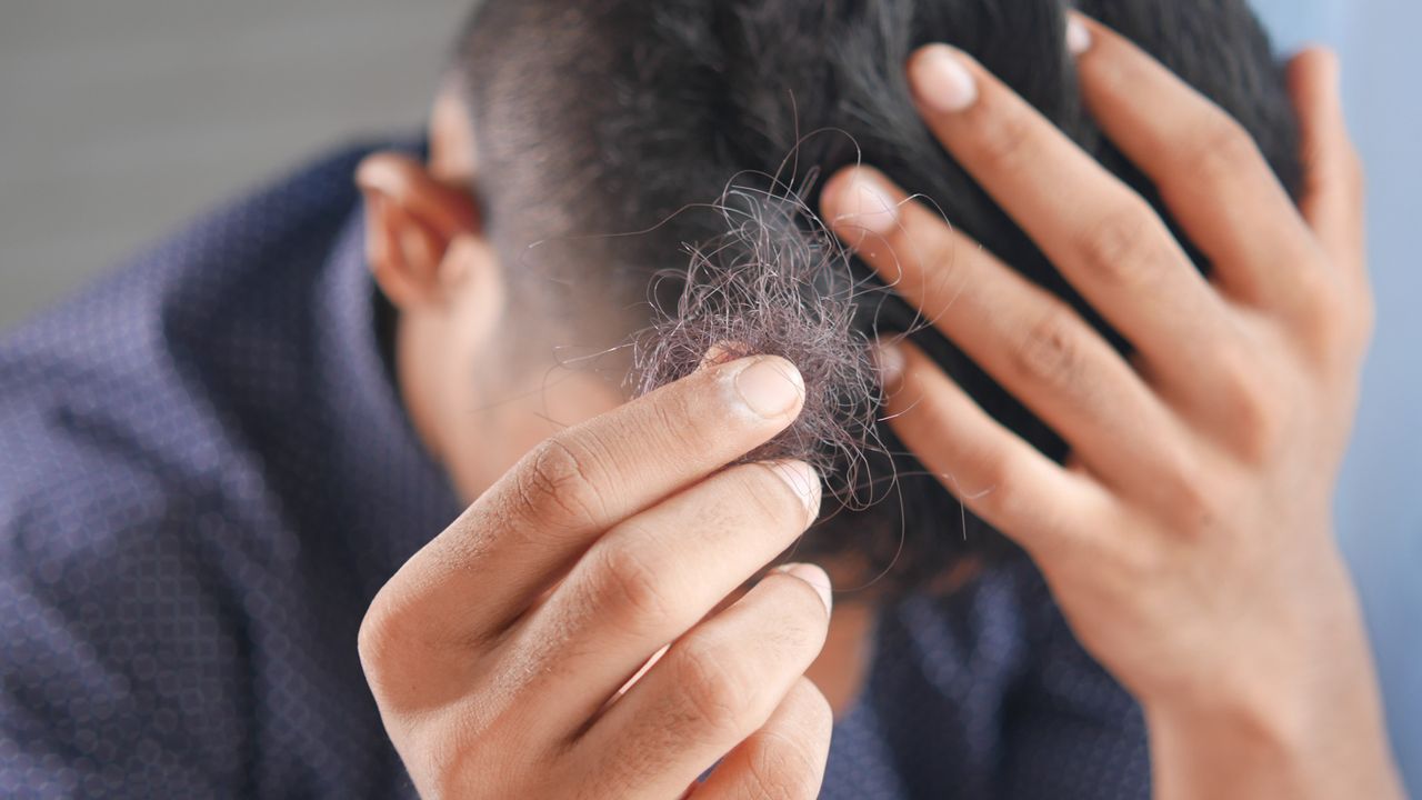 Rambut Menipis Hingga Botak, Kapan Sebaiknya Transplantasi Rambut Perlu Dilakukan?