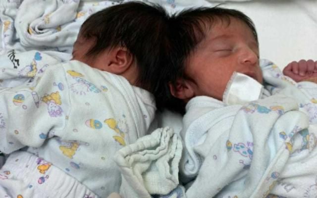 bayi kembar siam israel (Dok:Soroka University Medical Center in Beersheba)