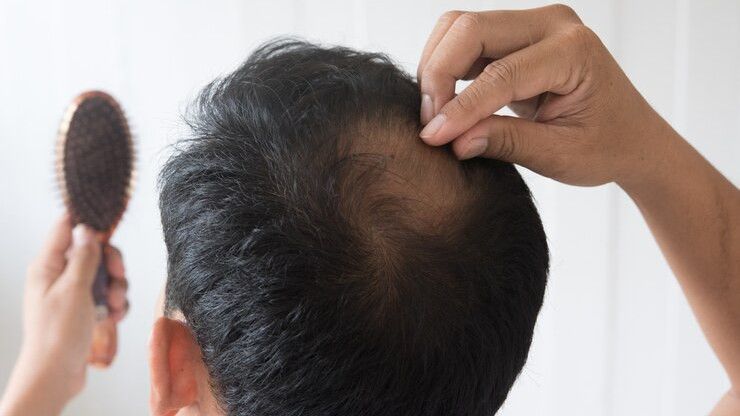 5 Cara Menumbuhkan Rambut Botak secara Alami dari Dalam dan Luar