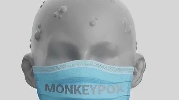 Satu Suspek Cacar Monyet Dirawat di RSP Unhas Makassar, Miliki Riwayat Perjalanan dari Jakarta