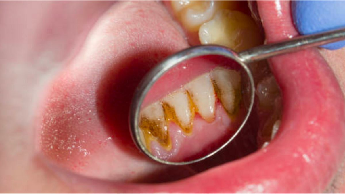 Proses Mematikan Saraf Gigi yang Harus Anda Ketahui