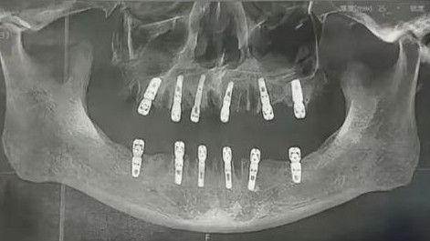 Kisah Tragis Pria di China, Cabut 23 Gigi dan Pasang 12 Implan Berujung Tewas