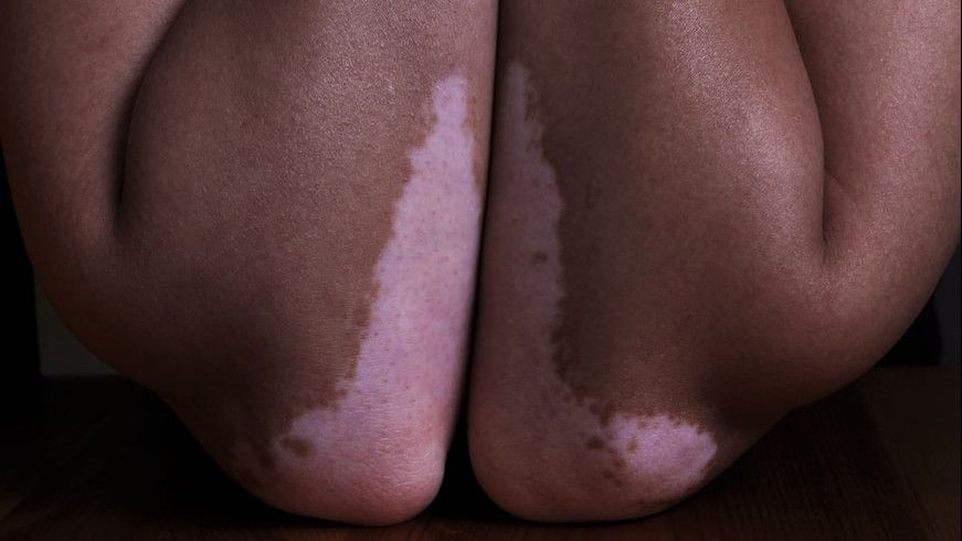 Apa Itu Vitiligo dan Apakah Bisa Disembuhkah?