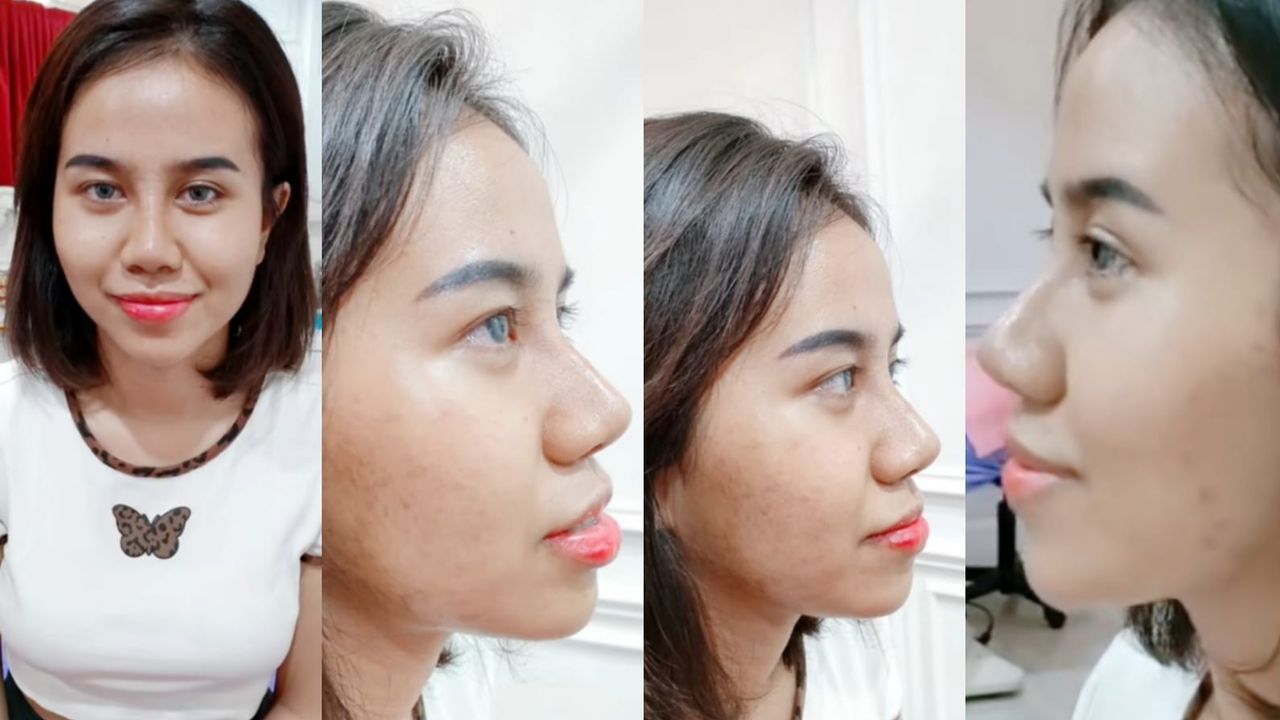 Berubah Jadi Mancung Pasca Oplas, Begini Penampakan Hidung Baru Mayang Seharga Rp50 Juta, Netizen: Mirip Barbie Kumalasari