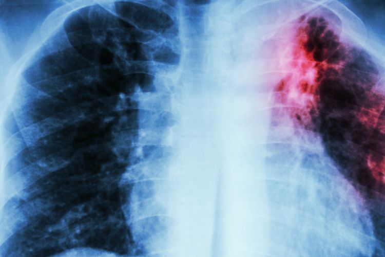 Indonesia Jadi Negara Terbanyak Ketiga untuk Jumlah Penderita TBC