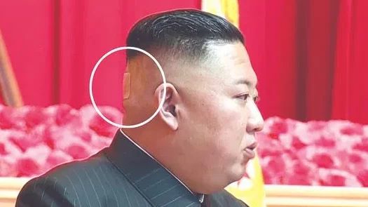 Foto Plester di Tengkuk Kepala Memicu Spekulasi Soal Kesehatan Kim Jong-un