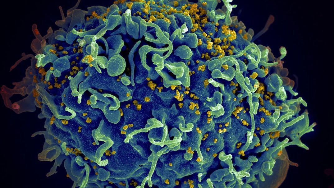 Cara Penularan HIV AIDS dan Pengobatan yang Paling Manjur