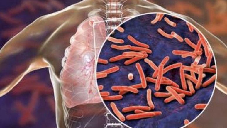Dianggap Lebih Bahaya, IDAI Sebut TBC Harus Dilacak Seperti COVID-19: Gejala Baru Muncul hingga Dua Tahun