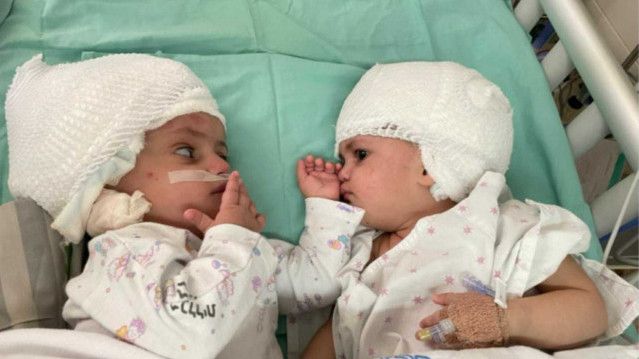 Bayi Kembar Siam di Israel Berhasil Dipisahkan Usai Operasi 12 Jam, Dokter Ungkap Pengalaman Luar Biasa