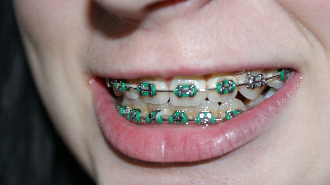 Efek Samping Penggunaan Kawat Gigi yang Perlu Diketahui