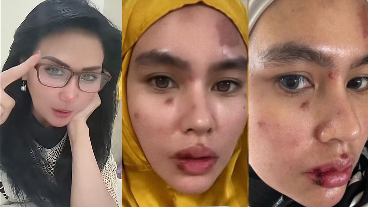Kartika Putri Dituding Kena Azab karena Wajahnya Dipenuhi Luka Lepuh, Psikolog Lita Gading: Nggak Boleh Menghujat