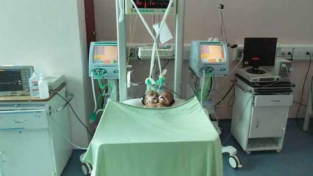 Bayi Kembar Siam Satu Badan Dua Kepala Meninggal di RSUP M Djamil, Sempat Dapat Perawatan Intensif