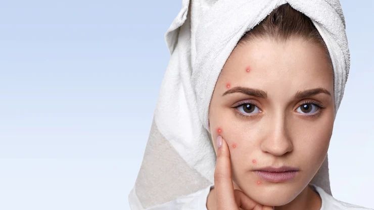 Inilah 4 Kandungan Skincare yang Ampuh Melawan Jerawat dalam Sekejap