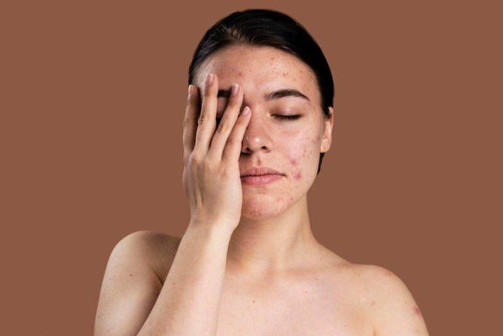 Kenali Penyebab Psoriasis di Wajah dan Cara Pengobatannya