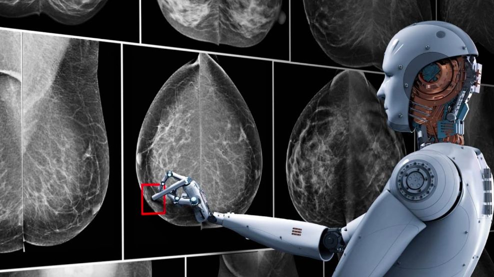 Pro dan Kontra Deteksi Dini Kanker Payudara dengan Mamografi AI