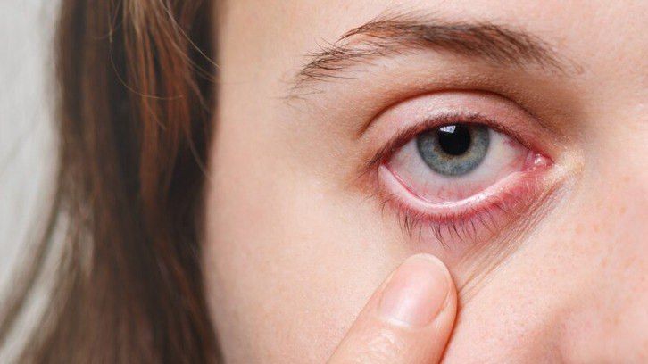 Penyebab Lemak di Selaput Mata, Penyakit Pterygium yang Bisa Ganggu Penglihatan