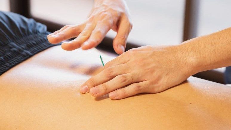 Teknologinya Kian Berkembang, Kenali 3 Jenis Akupunktur dari Kovensional hingga Tanam Benang