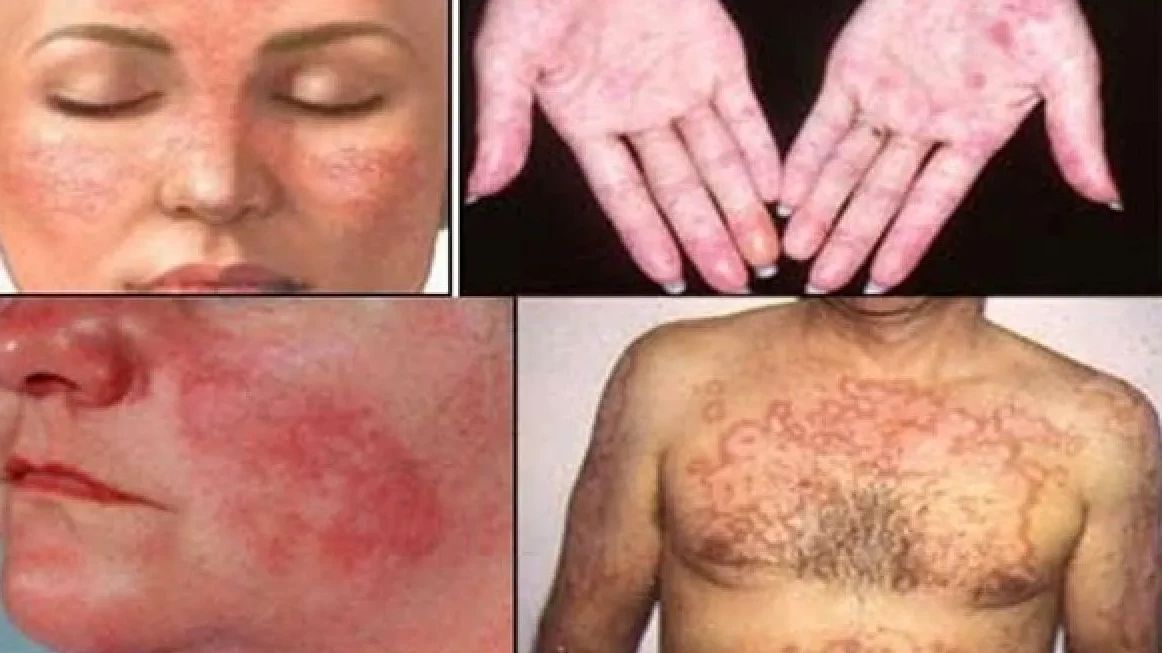 Empat Tanda Gejala Penyakit Lupus